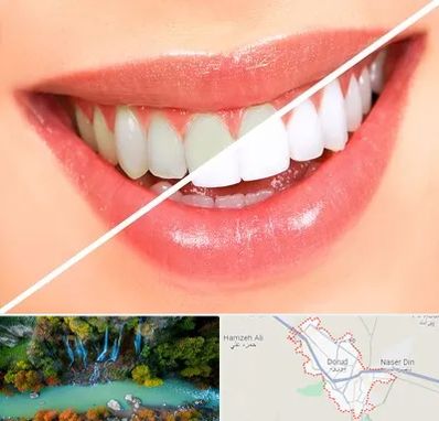 بلیچینگ دندان در دورود