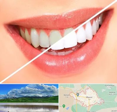 بلیچینگ دندان در مرند
