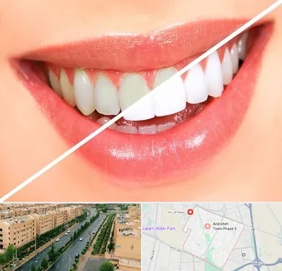 بلیچینگ دندان در فاز سه اندیشه
