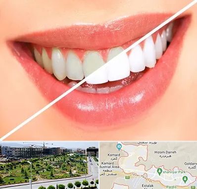 بلیچینگ دندان در پردیس