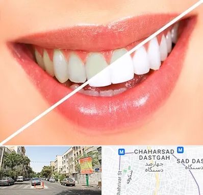 بلیچینگ دندان در چهارصد دستگاه 