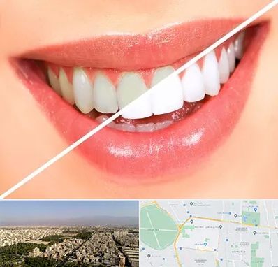 بلیچینگ دندان در نازی آباد