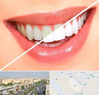 بلیچینگ دندان در کیانمهر کرج