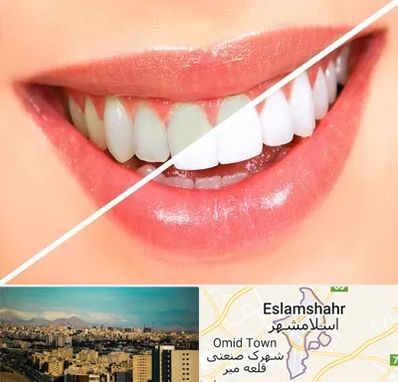 بلیچینگ دندان در اسلامشهر