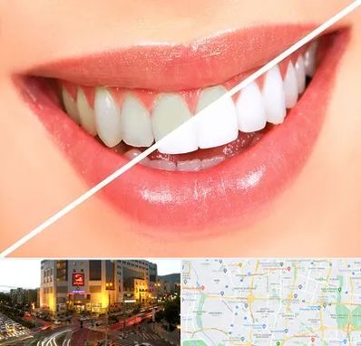 بلیچینگ دندان در جنت آباد تهران 