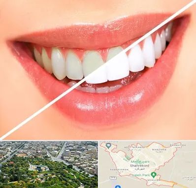 بلیچینگ دندان در شهرکرد