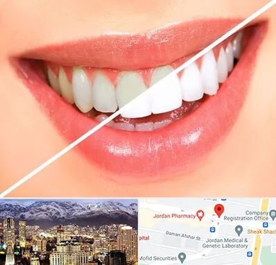 بلیچینگ دندان در جردن 