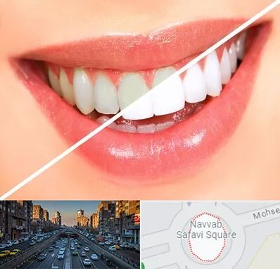 بلیچینگ دندان در نواب