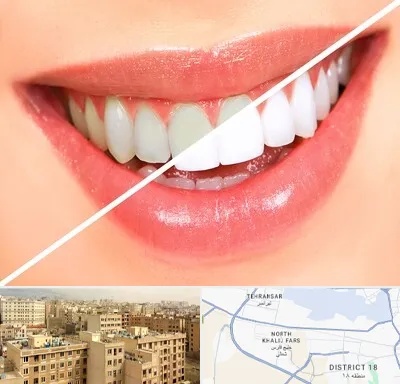 بلیچینگ دندان در جنوب غرب تهران
