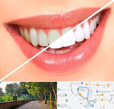 بلیچینگ دندان در فلکه گاز رشت