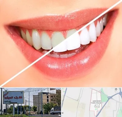 بلیچینگ دندان در فاز یک اندیشه