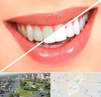 بلیچینگ دندان در کمال شهر کرج