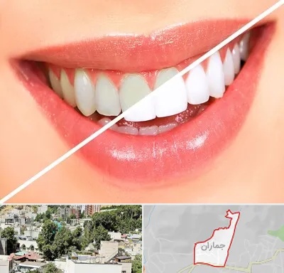 بلیچینگ دندان در جماران