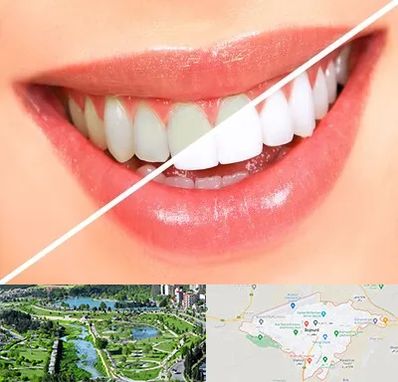 بلیچینگ دندان در بجنورد