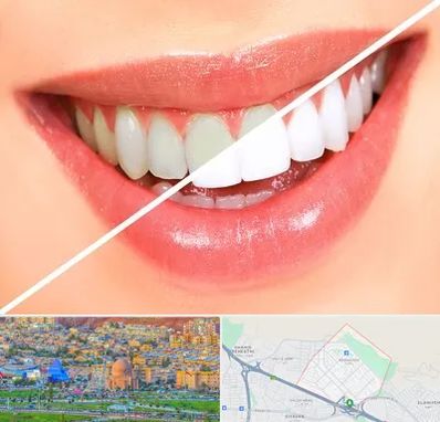 بلیچینگ دندان در رشدیه تبریز