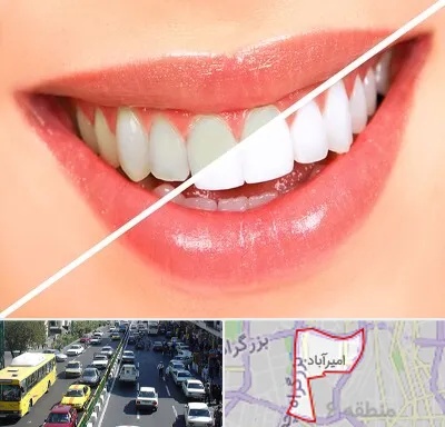 بلیچینگ دندان در امیرآباد