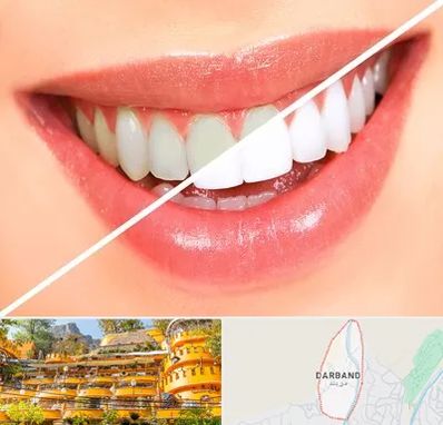 بلیچینگ دندان در دربند