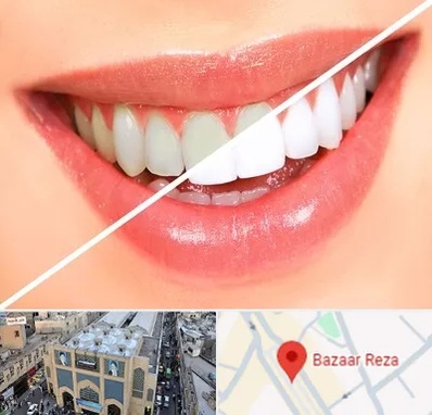 بلیچینگ دندان در بازار رضا مشهد