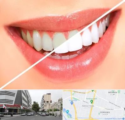 بلیچینگ دندان در بلوار فردوس 