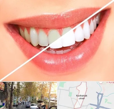 بلیچینگ دندان در کاشانک