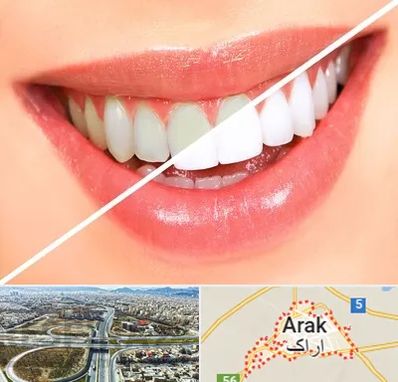 بلیچینگ دندان در اراک