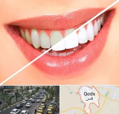 بلیچینگ دندان در شهر قدس