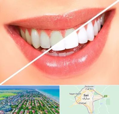 بلیچینگ دندان در ساری