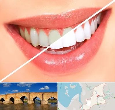 بلیچینگ دندان در بناب