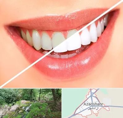 بلیچینگ دندان در آزادشهر