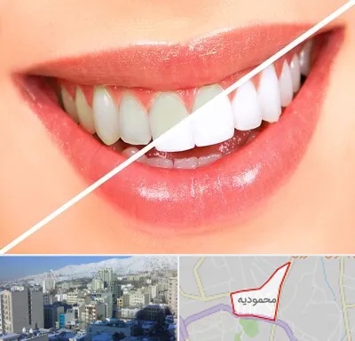 بلیچینگ دندان در محمودیه