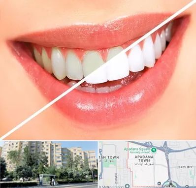 بلیچینگ دندان در آپادانا