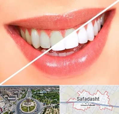 بلیچینگ دندان در صفادشت