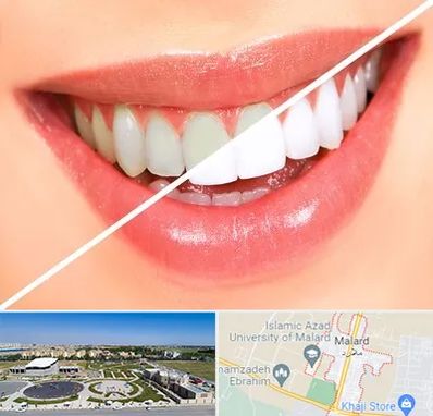 بلیچینگ دندان در ملارد