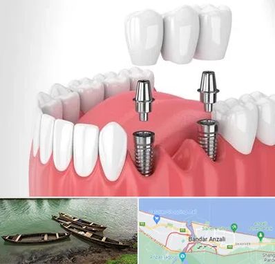 کاشت دندان در بندر انزلی