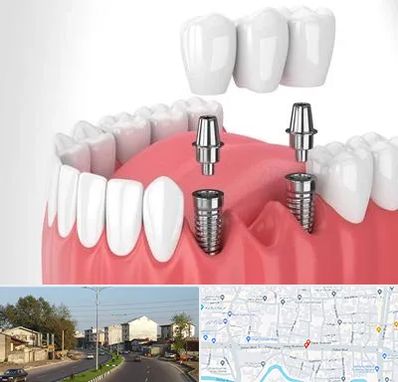 کاشت دندان در ضیابری رشت