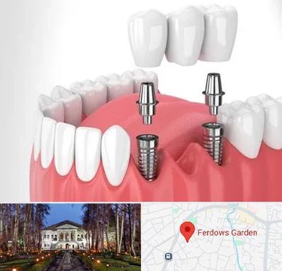 کاشت دندان در باغ فردوس