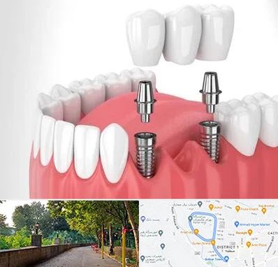 کاشت دندان در فلکه گاز رشت