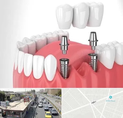 کاشت دندان در خیابان دماوند