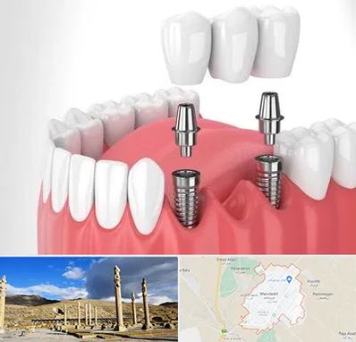 کاشت دندان در مرودشت