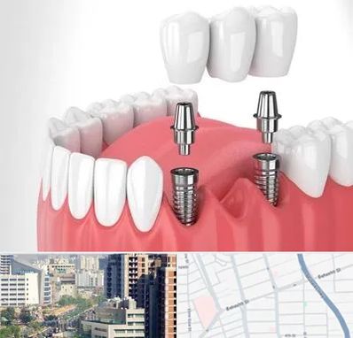 کاشت دندان در خیابان بهشتی