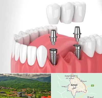 کاشت دندان در آمل