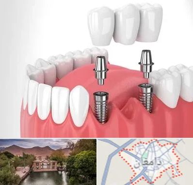 کاشت دندان در دامغان