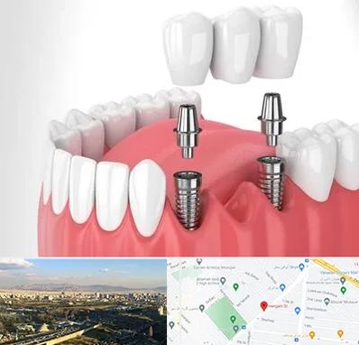 کاشت دندان در هنگام