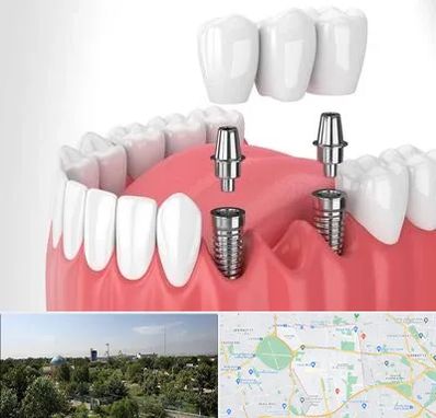 کاشت دندان در منطقه 16 تهران