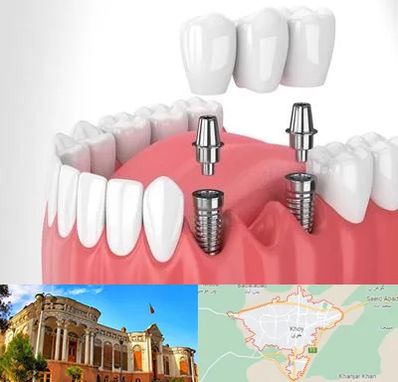 کاشت دندان در خوی