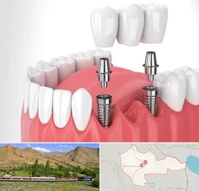 کاشت دندان در خاش