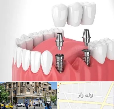 کاشت دندان در لاله زار