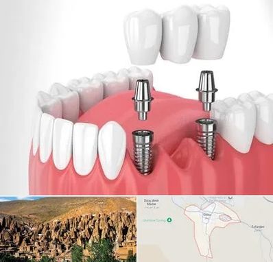 کاشت دندان در اسکو