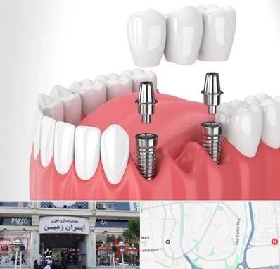 کاشت دندان در ایران زمین