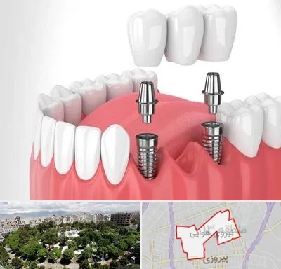 کاشت دندان در نیروی هوایی